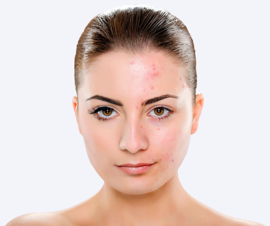 Roaccutane creme sans ordonnance